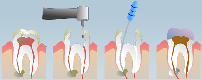 Endodonti (Kanal Tedavisi)